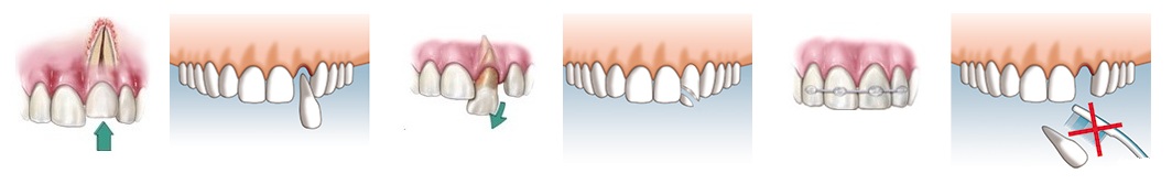 Перелом зуба в пределах дентина