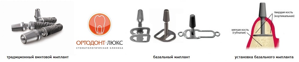Импланты в Калининграде цены и отзывы на имплантацию зубов