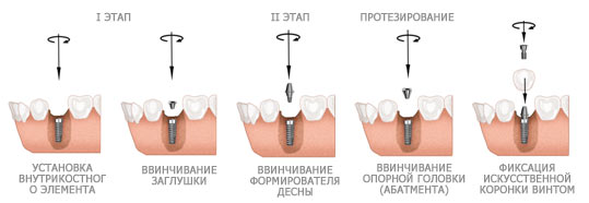 Имплантация зубов в Калининграде по цене, плюсы и минусы