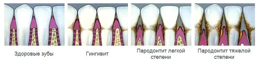 Выпадение зубов и основные причины потери зубов, эдентулизм