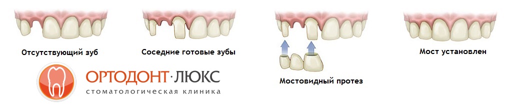 мостовидные зубные протезы в Калининграде