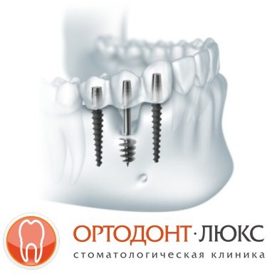 Имплантация зубов в Калининграде по доступной цене – Имплантация зубов в Калининграде - качественный и проверенный временем способ восстановления зубов и последующего протезирования на имплантах
