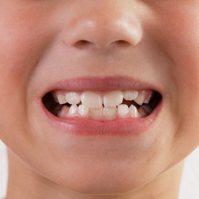 Кариес молочных зубов у детей в Калининграде и его лечение – Лечение кариеса молочных зубов у детей в Калининграде по доступной цене и рекомендации стоматолога
