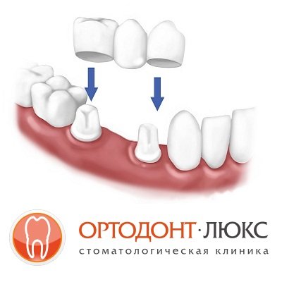 Имплантация зубов в Калининграде и доступная цена
