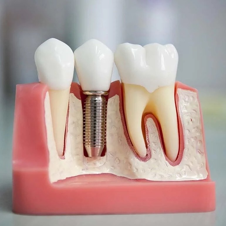Имплантация зубов в Калининграде – Имплантация зубов в Калининграде по хорошей стоимости, плюсы и минусы зубных имплантов в стоматологии