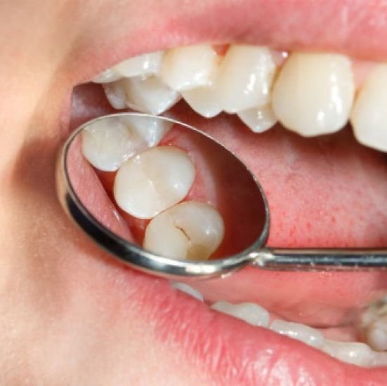 Лечение кариеса зубов в стадии пятна