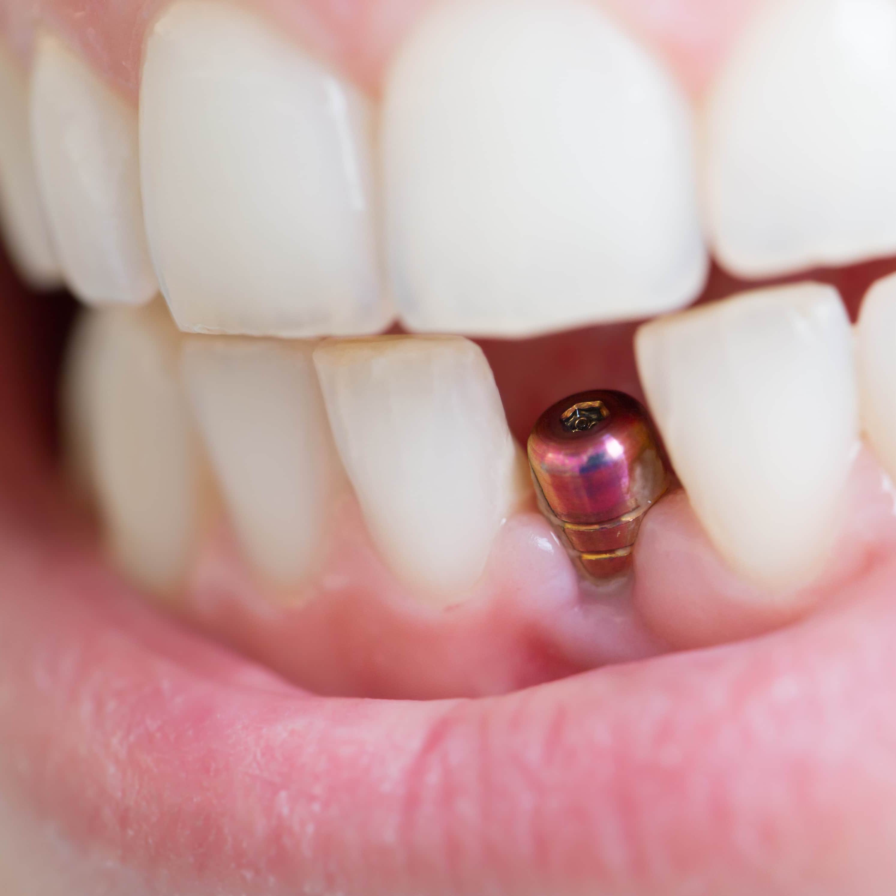 Мини импланты в Калининграде – Установка мини имплантов в Калининграде в ортодонтии по доступной цене в стоматологии