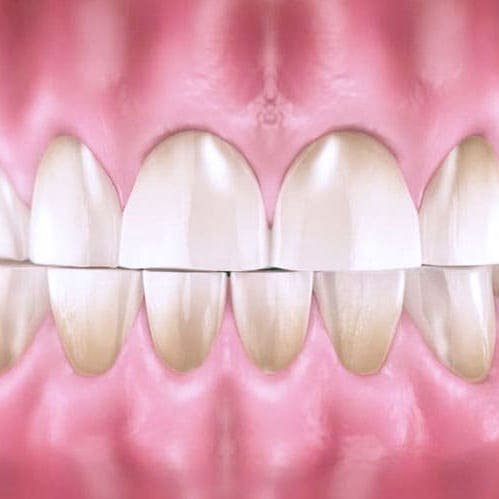 Стирание зубов, причины и лечение