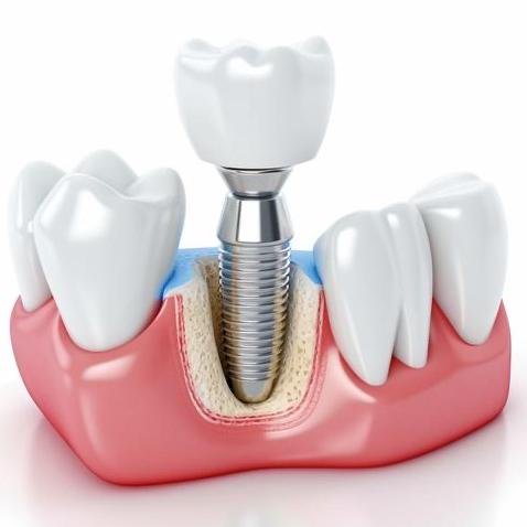 Имплантация зубов в Калининграде по цене со скидкой – Имплантация зубов в Калининграде по доступной цене и история появления имплантов в стоматологии
