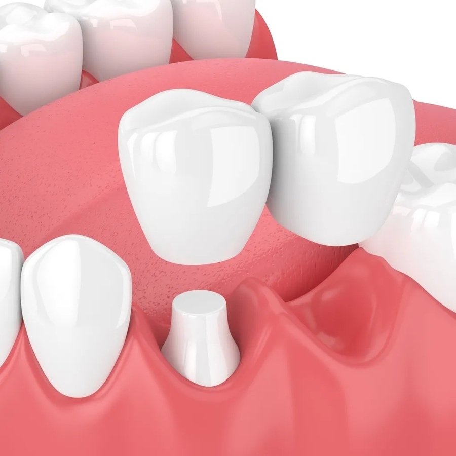 Мостовидный зубной протез из металлокерамики – Мост зубной и мостовидные зубные протезы из металлокерамики в Калининграде по доступной цене на протезирование