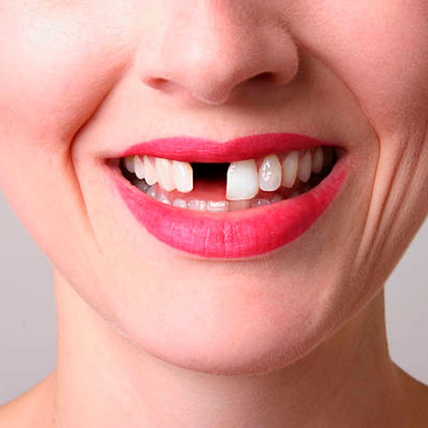 Выпадение зубов, эдентулизм причины – Выпадение зубов в Калининграде и причины преждевременной потери, эдентулизм в стоматологии