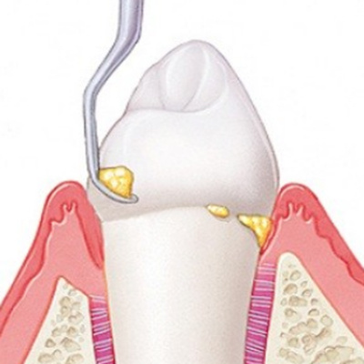 Профессиональная гигиена и чистка зубов в клинике Ортодонт-ЛЮКС: