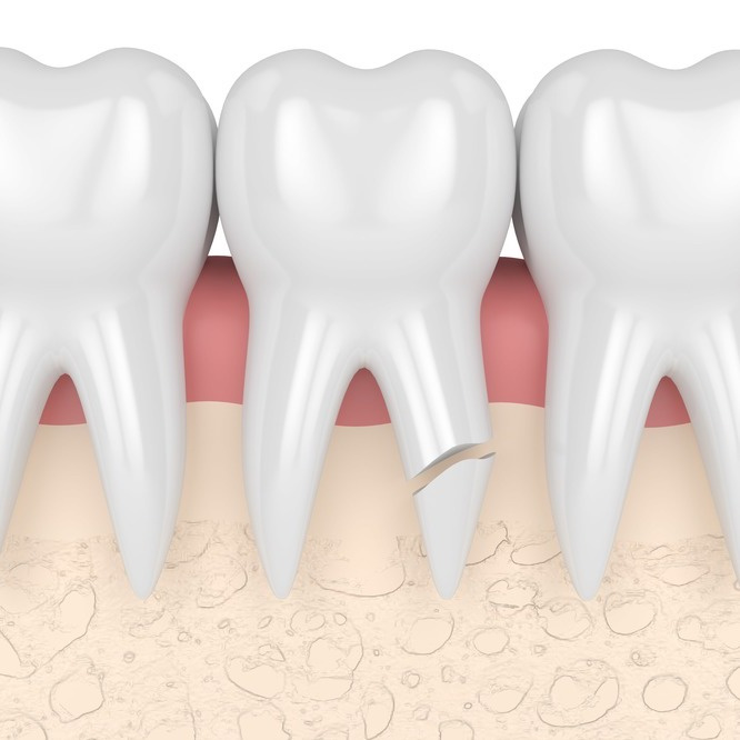Лечение травмы зубов и перелома корня – Перелом корня и лечение травмы зубов в Калининграде по доступной цене в стоматологии