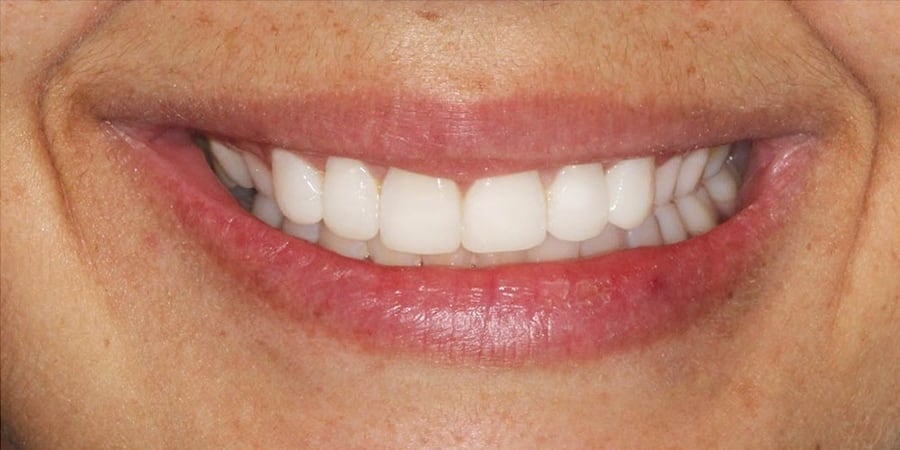 зубы после протирования на имплантах