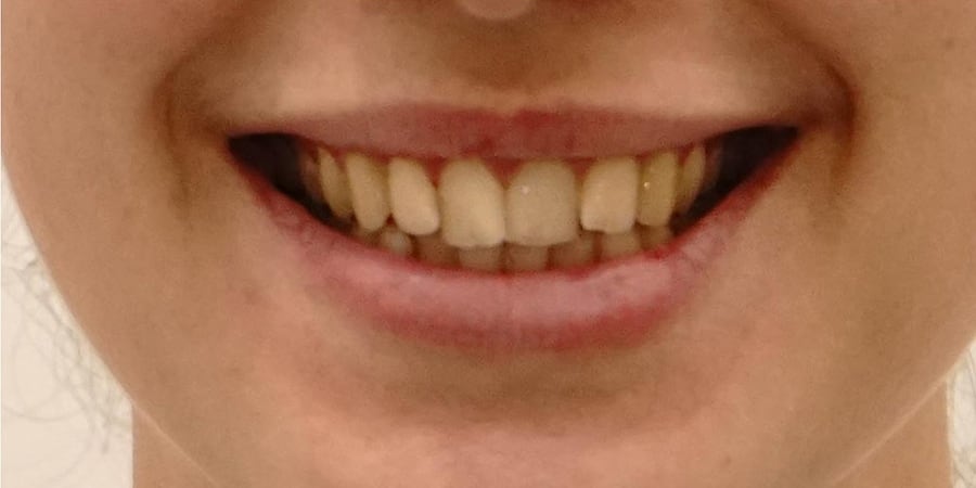 восстановление утраченных зубов
