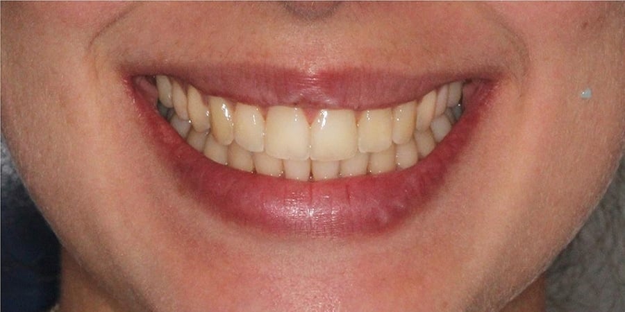 вариант восстановления зубов