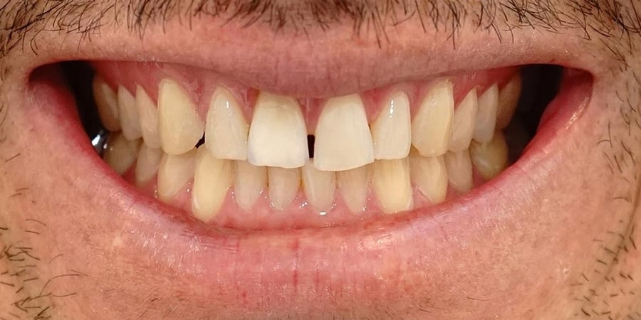 Зубы до ортопедического лечения