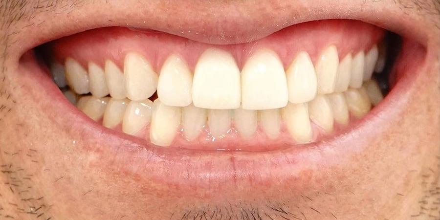 Зубы после ортопедического лечения