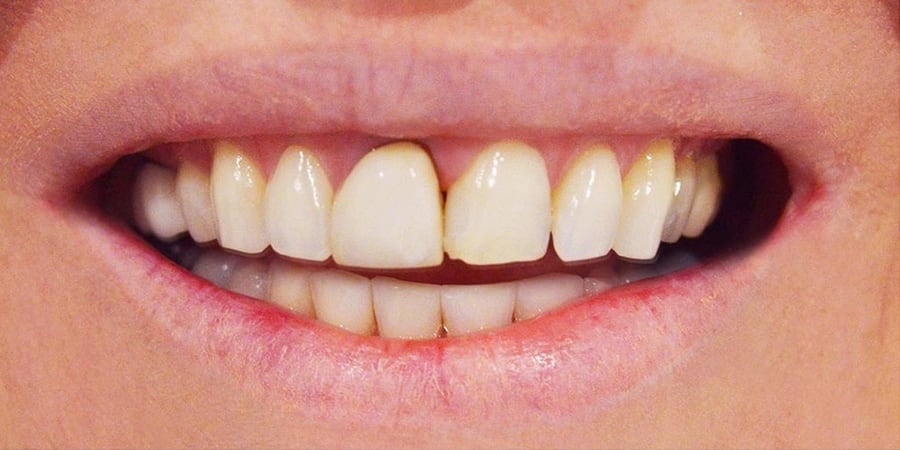 Зубы до протезирования