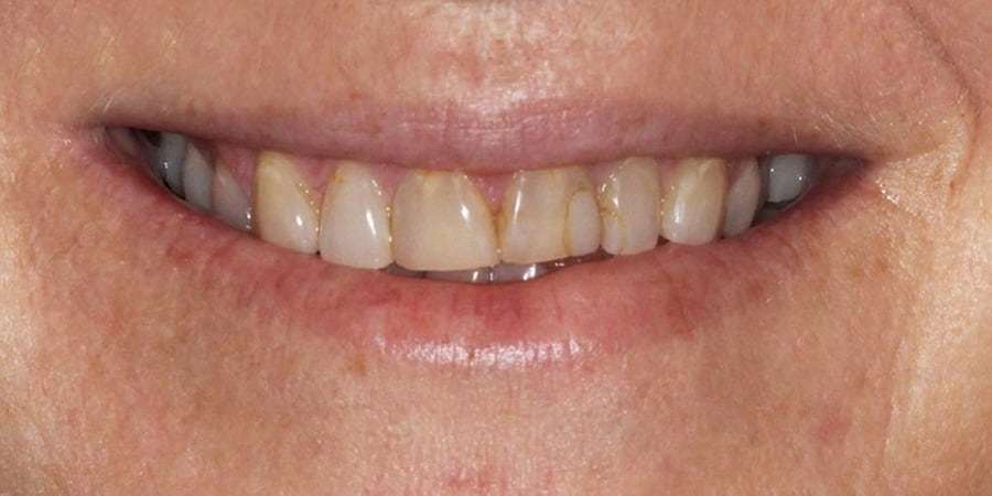 Зубы до похода в стоматологию