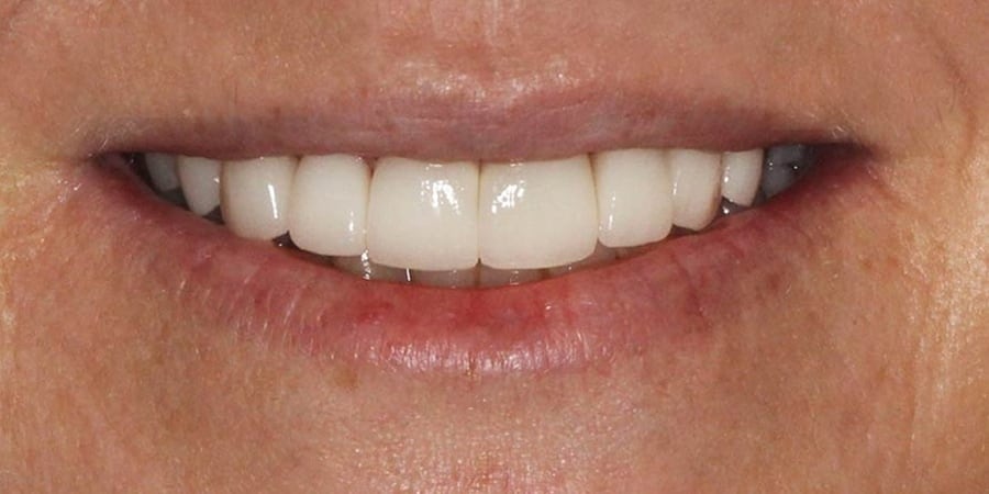 Зубы после посещения стоматологии
